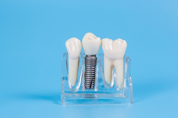 Understanding The Dental Implant Process